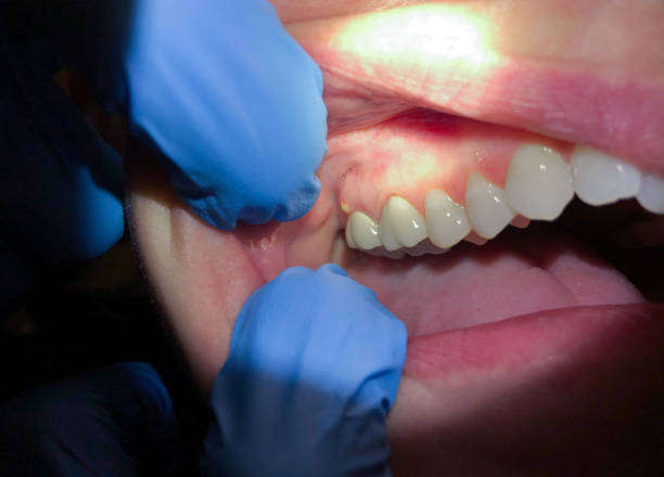 Best Emergency Dentist for Lost Fillings or Crowns in Loyola, CA